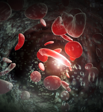Sickle cell