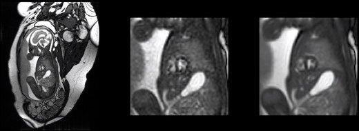 MRI 3D fetal heart 