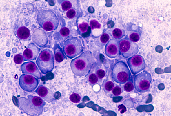 Myeloma blood cells shutterstock 729707917 listing