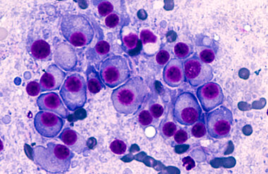 Myeloma blood cell stock image
